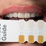 Tudo o que você precisa saber antes de fazer um clareamento dental!